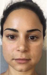 Botox μασητήρα