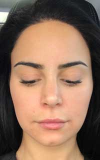 ΑBotox μασητήρα