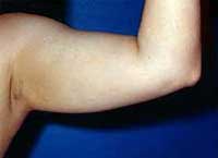 Βραχιονοπλαστική