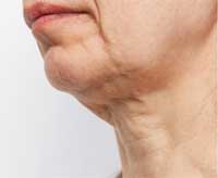 Botox λαιμου