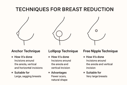 Μείωση στήθους πως γίνεται
